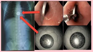 FOREIGN BODY REMOVAL !! COIN !! ফরেন বডি রিমুভাল !! কয়েন / টাকা #BD_ENDOSCOPY