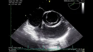 Unicuspid unicommissural aortic valve: an extremely rare congenital anomaly