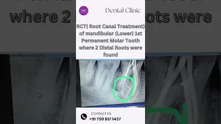 RCT( root canal treatment) of mandibular (lower) 1st permanent molar tooth