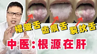 裂纹舌、褶皱舌、齿痕舌，如何调理？中医：先疏肝，再健脾！   【舌诊案例分析】