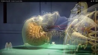 3D Medical Video (HD) - Cerebral Aneurysm Coiling