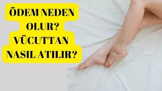 ÖDEM NEDEN OLUR?VÜCUTTAN NASIL ATILIR?