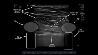 Ultrasound of Pneumothorax