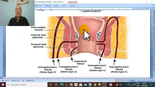 Anal Disorders in Arabic 8  (Anal Fistula , parts 2 ) , by Dr. Wahdan