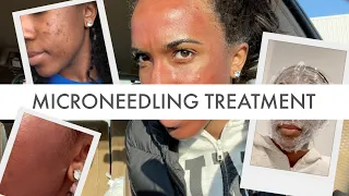 MicroNeedling Treatment For Acne Scars + My Experience