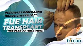 РЕЗУЛЬТАТ ПЕРЕСАДКИ ВОЛОС СПУСТЯ ГОДl FUE HAIR TRANSPLANT RESULTS AFTER 1 YEAR