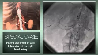 Thoracoabdominal aortic aneurysm: a totally endovascular approach with a branched stent-graft