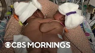 Conjoined twins separated by Texas doctors after "historic" 11-hour surgery