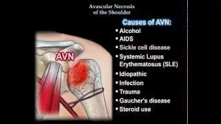 AVN Of The Shoulder - Everything You Need To Know - Dr. Nabil Ebraheim