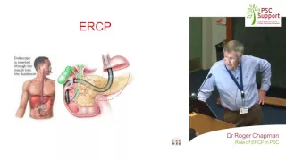 Dr Roger Chapman - The role of ERCP in PSC, PSC Support 2016 Oxford Meeting