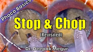 Phaco Basics- Stop & Chop Technique - Revisited. (2023)