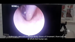 Foreign body ear|Ear care| stone in ear| Endoscopic removal of foreign b|Endoscopy|DrAnil Kumar Jain