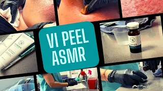 VI PEEL ASMR | ACNE ICE PICK SCAR TREATMENT