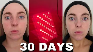 I Tried RED LIGHT THERAPY For 30 Days & THIS Is What Happened: Worth It??