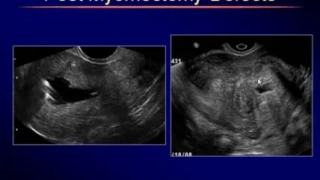 Sonography of Uterine Myometrial Disorders