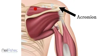 Supraspinatus - How To Find Trigger Points (Shoulder Pain)