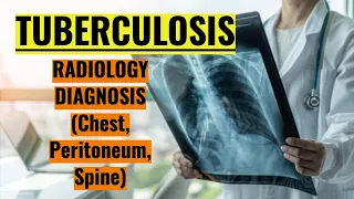 Tuberculosis (Tb), Tuberculosis x-ray, Tb chest x-ray.