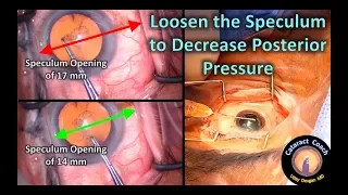Loosen the speculum to decrease posterior pressure in Cataract surgery