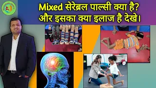 Mixed सेरेब्रल पाल्सी क्या है? और इसका क्या इलाज है देखे|