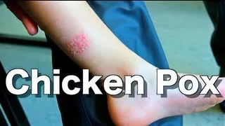 Chicken Pox (Varicella-Zoster) -Ask Your Pediatrician-