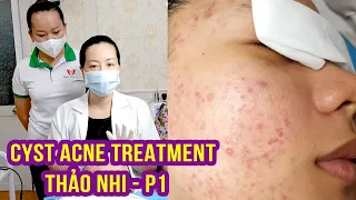 Cyst Acne Treatment | Điều trị mụn hiệu quả số 1 Hiền Vân Spa | Thảo Nhi | Part 1 | 522