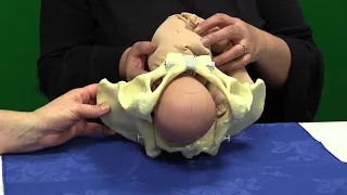 Mechanism of Occipitoposterior Labour - Long Rotation