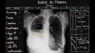 Radio du thorax - Quiz - Partie 3 - Docteur Synapse