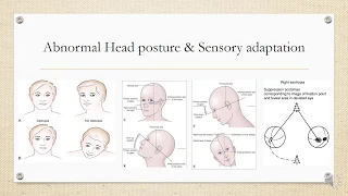 Paralytic squint and it's clinical features