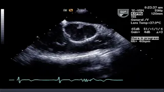 Unicuspid Aortic Valve TEE