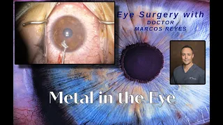 Metal in the eye