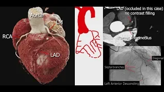 Coronary Artery Anatomy & Imaging