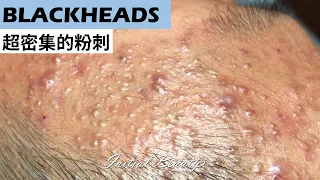 超密集的粉刺(blackheads) part 1 - Taiwan Tainan台南清粉刺最乾淨