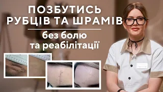 РУБЦІ: як позбутись без болю та реабілітації?