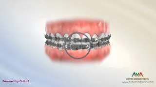 Orthodontic Treatment for Dental Midline - Rubber Bands