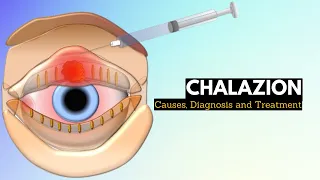 CHALAZION, Causes, Signs and Symptoms, Diagnosis and Treatment.
