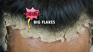 Picking BIG Scalp Flakes Psoriasis Satisfying #745