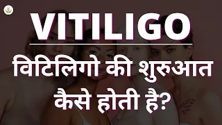 विटिलिगो की शुरुआत कैसे होती है? | How Does Vitiligo Start: Symptoms? | Care Well Medical Centre