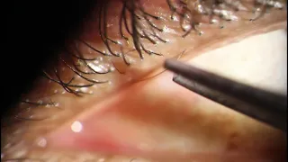 Trichiasis Epilation - TWO eyelashes out of ONE meibomian gland