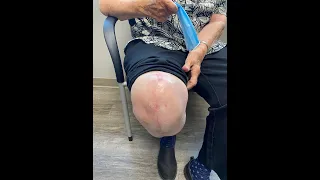 6 Week Follow Up Revision Knee Replacement with Robert Cagle MD | Femur Fracture Knee Replacement