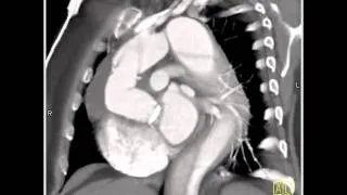 Vascular: Type A Dissection of the Aorta following Valve Replacement and Composite Graft(4 of 4)