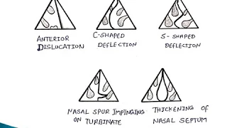 Deviated Nasal Septum | ENT Lecture Series