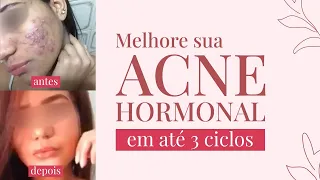 Acne hormonal: como tratar de forma natural com o ciclo das sementes