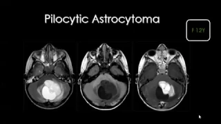 Dr Mamdouh Mahfouz pediatric imaging brain tumors   YouTube