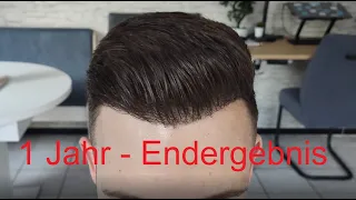 Endergebnis! Ein Jahr nach der Haartransplantation bei Elithair