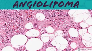 Angiolipoma: 5-Minute Pathology Pearls