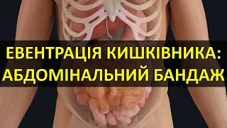 ЕВЕНТРАЦІЯ КИШКІВНИКА. АБДОМІНАЛЬНИЙ БАНДАЖ. Особливості медичної допомоги (NAR Abdominal/Stump ETD)