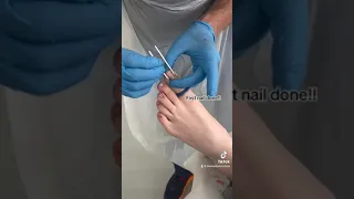 Triple Nail Surgery: Say Goodbye to Ingrown Toenails Forever! 👋🏽