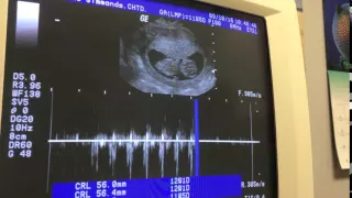 Baby's Heart Beat at 11 Weeks Pregnant