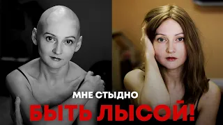 «Я – урод». Алопеция — приговор для женщины?