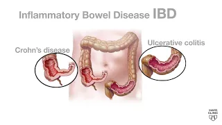 Mayo Clinic Minute: What is inflammatory bowel disease?